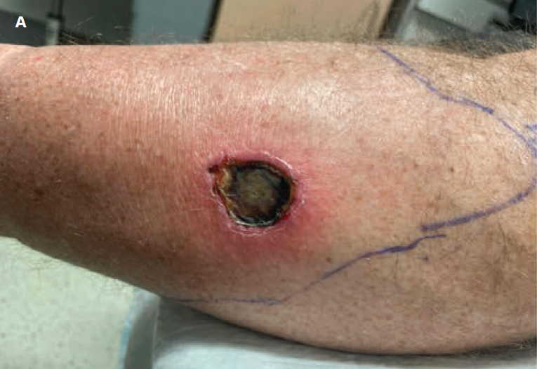 Full Thickness Burn Resulting From An E Sock A Case Report 